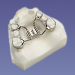 palatal expander